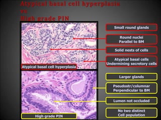 Atypical basal cell hyperplasia
vs
High grade PIN
Small round glands
Larger glands
No two distinct
Cell population
Atypical basal cells
Undermining secretory cells
Lumen not occluded
Solid nests of cells
Pseudostr/columnar
Perpendicular to BM
Round nuclei
Parallel to BM
Atypical basal cell hyperplasia
High grade PIN
 