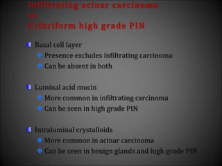 Basal cell layer
Presence excludes infiltrating carcinoma
Can be absent in both
Luminal acid mucin
More common in infiltrating carcinoma
Can be seen in high grade PIN
Intraluminal crystalloids
More common in acinar carcinoma
Can be seen in benign glands and high grade PIN
Infiltrating acinar carcinoma
vs
Cribriform high grade PIN
 