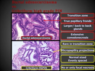 Ductal adenocarcinoma
vs
Cribriform high grade PIN
Transition zone
Rare in transition zone
Larger/ back to back
glands
Normal sized
Evenly spaced
Extensive
comedonecrosis
No or only focal necrosis
True papillary fronds
Micropapillry projections
Ductal adenocarcinoma
Cribriform HGPIN
 