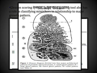•Gleason scoring system other than grading tool also has
a role in classifying mimickers in relationship to major
growth pattern.
 