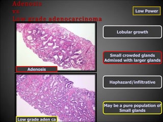 Adenosis
vs
Low grade adenocarcinoma
Lobular growth
Haphazard/infiltrative
Small crowded glands
Admixed with larger glands
May be a pure population of
Small glands
Adenosis
Low grade aden ca
Low Power
 