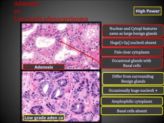 Adenosis
vs
Low grade adenocarcinoma
High Power
Huge[>3µ] nucleoli absent
Occasionally huge nucleoli +
Nuclear and Cytopl features
same as large benign glands
Differ from surrounding
Benign glands
Pale clear cytoplasm
Amphophilic cytoplasm
Occasional glands with
Basal cells
Basal cells absent
Adenosis
Low grade aden ca
 