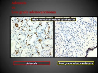Adenosis
vs
Low grade adenocarcinoma
Adenosis Low grade adenocarcinoma
High molecular weight cytokeratin
 