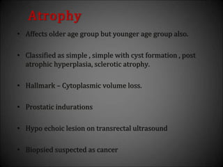 Atrophy
• Affects older age group but younger age group also.
• Classified as simple , simple with cyst formation , post
atrophic hyperplasia, sclerotic atrophy.
• Hallmark – Cytoplasmic volume loss.
• Prostatic indurations
• Hypo echoic lesion on transrectal ultrasound
• Biopsied suspected as cancer
 