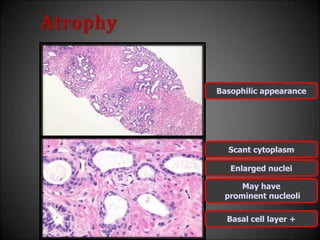 Atrophy
Basophilic appearance
Scant cytoplasm
Enlarged nuclei
May have
prominent nucleoli
Basal cell layer +
 
