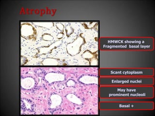 HMWCK showing a
Fragmented basal layer
Atrophy
Scant cytoplasm
Enlarged nuclei
May have
prominent nucleoli
Basal +
 