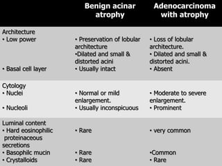 Benign acinar
atrophy
Adenocarcinoma
with atrophy
Architecture
• Low power
• Basal cell layer
• Preservation of lobular
architecture
•Dilated and small &
distorted acini
• Usually intact
• Loss of lobular
architecture.
• Dilated and small &
distorted acini.
• Absent
Cytology
• Nuclei
• Nucleoli
• Normal or mild
enlargement.
• Usually inconspicuous
• Moderate to severe
enlargement.
• Prominent
Luminal content
• Hard eosinophilic
proteinaceous
secretions
• Basophilc mucin
• Crystalloids
• Rare
• Rare
• Rare
• very common
•Common
• Rare
 