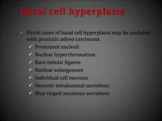 Basal cell hyperplasia
• Florid cases of basal cell hyperplasia may be confused
with prostatic adeno carcinoma
 Prominent nucleoli
 Nuclear hyperchromatism
 Rare mitotic figures
 Nuclear enlargement
 Individual cell necrosis
 Necrotic intraluminal secretions
 Blue tinged mucinous secretions
 