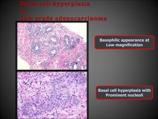 Basal cell hyperplasia
vs
Low grade adenocarcinoma
Basophilic appearance at
Low magnification
Basal cell hyperplasia with
Prominent nucleoli
 