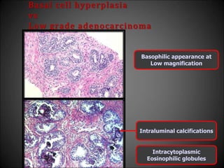 Basal cell hyperplasia
vs
Low grade adenocarcinoma
Basophilic appearance at
Low magnification
Intraluminal calcifications
Intracytoplasmic
Eosinophilic globules
 