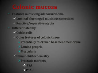 Colonic mucosa
• Features mimicking adenocarcinoma
 Luminal blue tinged mucinous secretions
 Reactive/reparative atypia
• Differentiated by
 Goblet cells
 Other features of colonic tissue
Potentially thickened basement membrane
Lamina propria
Muscularis
 Immunohistochemistry
Prostatic markers
 PSA
PSAP
 