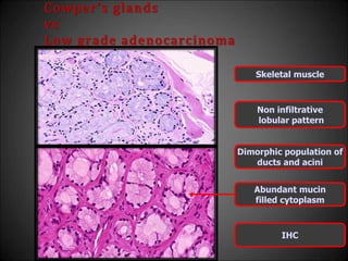 Cowper’s glands
vs
Low grade adenocarcinoma
Skeletal muscle
Non infiltrative
lobular pattern
Dimorphic population of
ducts and acini
Abundant mucin
filled cytoplasm
IHC
 
