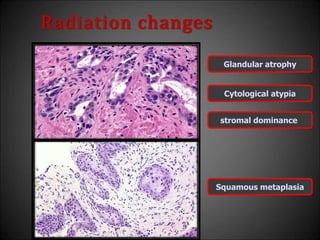 Radiation changes
Glandular atrophy
Cytological atypia
stromal dominance
Squamous metaplasia
 