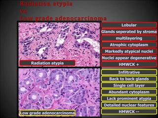 Radiation atypia
vs
Low grade adenocarcinoma
Lobular
Infiltrative
Glands seperated by stroma
Back to back glands
multilayering
Single cell layer
Atrophic cytoplasm
Abundant cytoplasm
Markedly atypical nuclei
Lack prominent atypia
Nuclei appear degenerative
Detailed nuclear features
Radiation atypia
Low grade adenocarcinoma
HMWCK +
HMWCK --
 