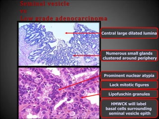 Seminal vesicle
vs
Low grade adenocarcinoma
Numerous small glands
clustered around periphery
Central large dilated lumina
Prominent nuclear atypia
Lack mitotic figures
Lipofuschin granules
HMWCK will label
basal cells surrounding
seminal vesicle epith
 