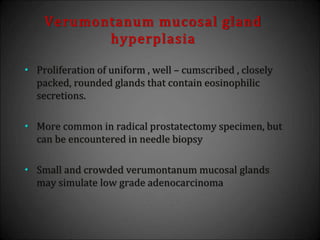 Verumontanum mucosal gland
hyperplasia
• Proliferation of uniform , well – cumscribed , closely
packed, rounded glands that contain eosinophilic
secretions.
• More common in radical prostatectomy specimen, but
can be encountered in needle biopsy
• Small and crowded verumontanum mucosal glands
may simulate low grade adenocarcinoma
 