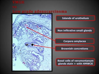 VMGH
vs
Low grade adenocarcinoma
Islands of urothelium
Non infitrative small glands
Corpora amylacea
Brownish concretions
Basal cells of verumontanum
glands stain + with HMWCK
 