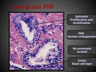 Low grade PIN
No prominent
nucleoli
Mild
Nuclear enlargement
Epithelial
Proliferation and
stratification
Intact
Basal cell layer
 