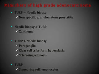 Mimickers of high grade adenocarcinoma
• TURP = Needle biopsy
 Non specific granulomatous prostatitis
• Needle biopsy > TURP
 Xanthoma
• TURP > Needle biopsy
 Paraganglia
 Clear cell cribriform hyperplasia
 Sclerosing adenosis
• TURP
 Signet ring cell lymphocytes
 
