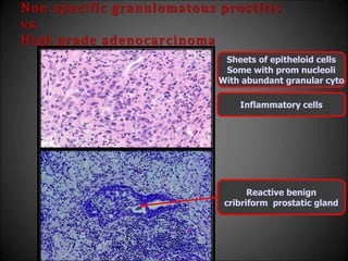 Non specific granulomatous prostitis
vs.
High grade adenocarcinoma
Sheets of epitheloid cells
Some with prom nucleoli
With abundant granular cyto
Reactive benign
cribriform prostatic gland
Inflammatory cells
 