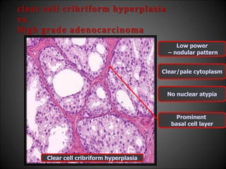 clear cell cribriform hyperplasia
vs.
High grade adenocarcinoma
Clear/pale cytoplasm
Prominent
basal cell layer
No nuclear atypia
Clear cell cribriform hyperplasia
Low power
– nodular pattern
 