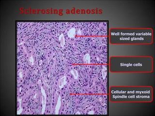 Sclerosing adenosis
Well formed variable
sized glands
Single cells
Cellular and myxoid
Spindle cell stroma
 