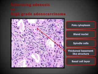 Sclerosing adenosis
vs
High grade adenocarcinoma
Pale cytoplasm
Bland nuclei
Spindle cells
Thickened basement
like structure
Basal cell layer
 