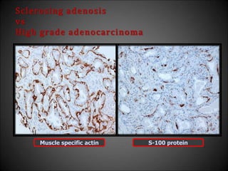Sclerosing adenosis
vs
High grade adenocarcinoma
Muscle specific actin S-100 protein
 