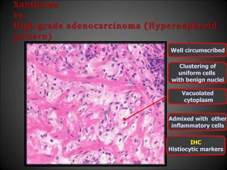 Xanthoma
vs.
High grade adenocarcinoma (Hypernephroid
pattern)
Well circumscribed
Clustering of
uniform cells
with benign nuclei
Admixed with other
inflammatory cells
IHC
Histiocytic markers
Vacuolated
cytoplasm
 