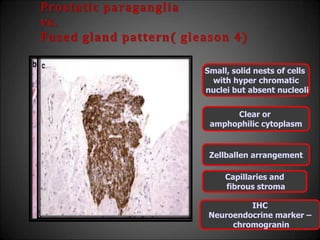 Prostatic paraganglia
vs.
Fused gland pattern( gleason 4)
Small, solid nests of cells
with hyper chromatic
nuclei but absent nucleoli
Clear or
amphophilic cytoplasm
Zellballen arrangement
Capillaries and
fibrous stroma
IHC
Neuroendocrine marker –
chromogranin
 