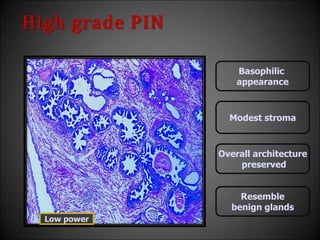 High grade PIN
Modest stroma
Overall architecture
preserved
Resemble
benign glands
Basophilic
appearance
Low power
 