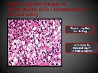 Signet ring like changes in
Nonepithelial cells ( Lymphocytes &
stromal cells)
Signet ring like
morphology
Secondary to
thermal injury
(in TUR specimen)
 