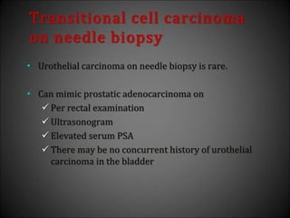 Transitional cell carcinoma
on needle biopsy
• Urothelial carcinoma on needle biopsy is rare.
• Can mimic prostatic adenocarcinoma on
 Per rectal examination
 Ultrasonogram
 Elevated serum PSA
 There may be no concurrent history of urothelial
carcinoma in the bladder
 