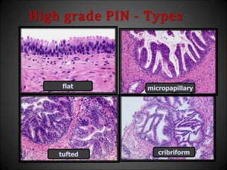 High grade PIN - Types
cribriform
micropapillary
tufted
flat
 