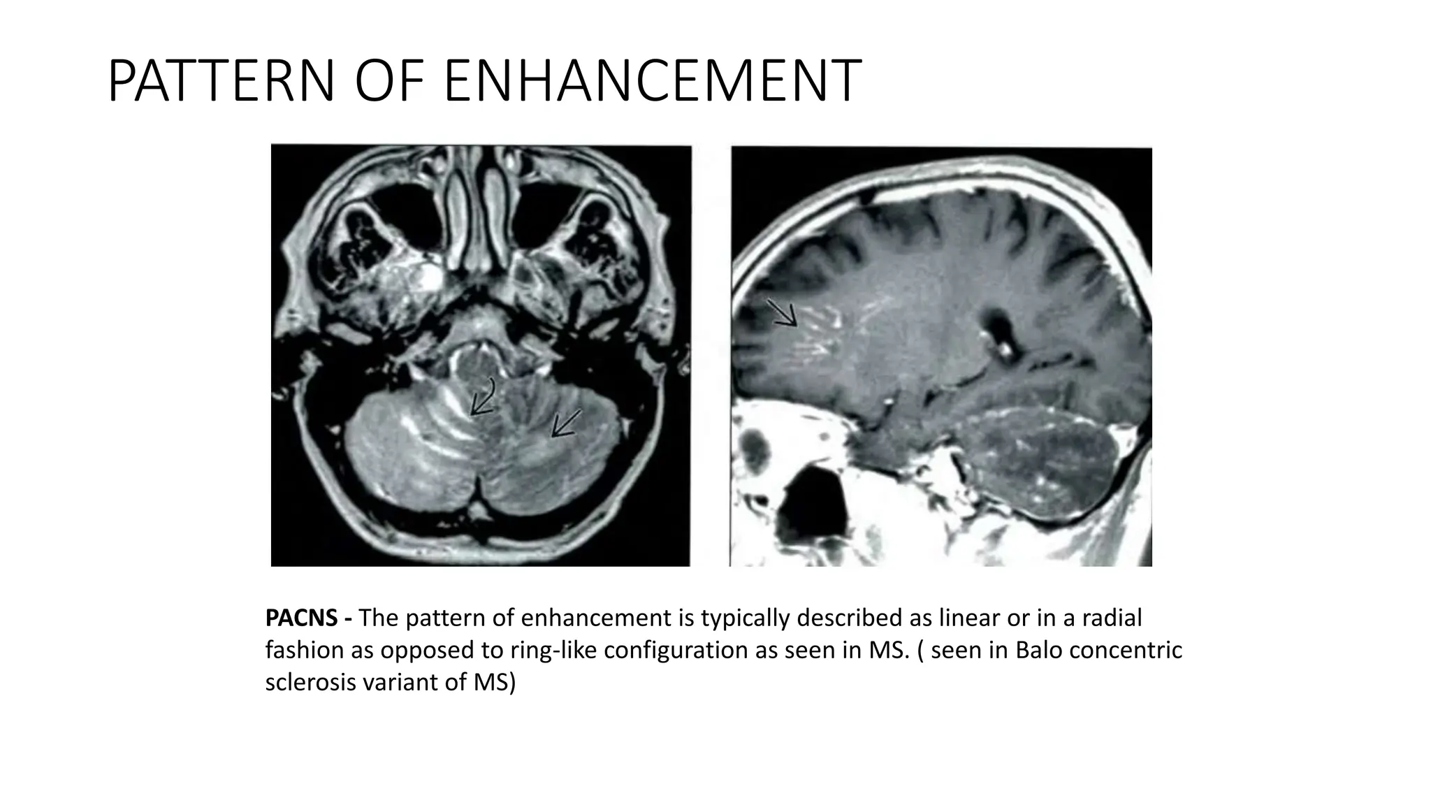Mimics of MS in MRI copy for neurologist | PPTX