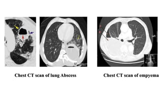 Chest CT scan of lung Abscess Chest CT scan of empyema
 