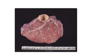 RADIOLOGICAL INVESTIGATION ON LUNG ABSCESS
 