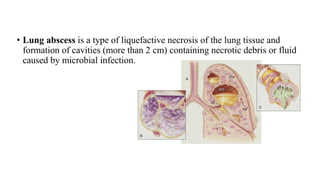 • Lung abscess is a type of liquefactive necrosis of the lung tissue and
formation of cavities (more than 2 cm) containing necrotic debris or fluid
caused by microbial infection.
 