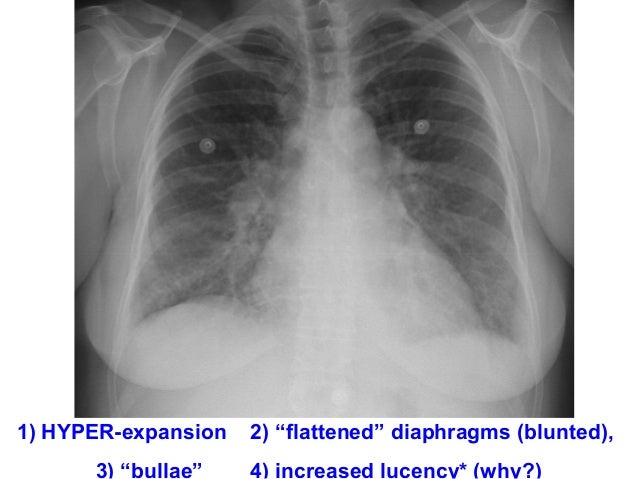 Minarcik robbins 2013_ch15-lung