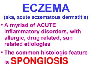 ECZEMA

(aka, acute eczematous dermatitis)

• A myriad of ACUTE
inflammatory disorders, with
allergic, drug related, sun
related etiologies
• The common histologic feature
is

SPONGIOSIS

 
