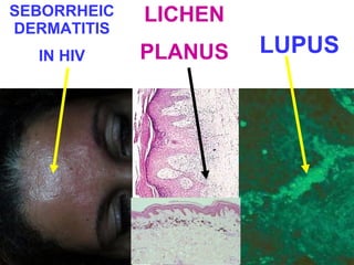 SEBORRHEIC
DERMATITIS

LICHEN

IN HIV

PLANUS

LUPUS

 