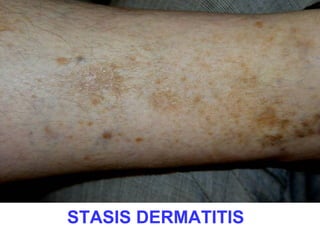 STASIS DERMATITIS

 