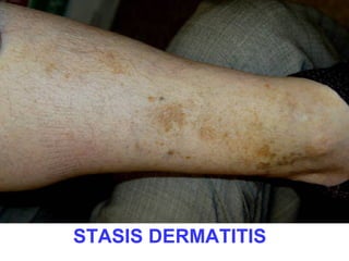 STASIS DERMATITIS

 