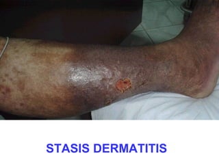 STASIS DERMATITIS

 