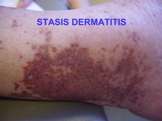 STASIS DERMATITIS

 
