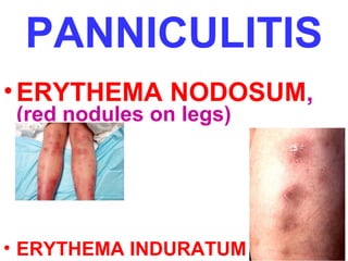 PANNICULITIS
• ERYTHEMA NODOSUM,
(red nodules on legs)

• ERYTHEMA INDURATUM

 