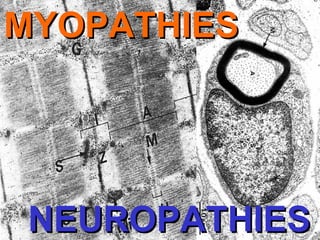 MYOPATHIES

NEUROPATHIES

 