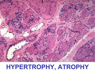 HYPERTROPHY, ATROPHY

 