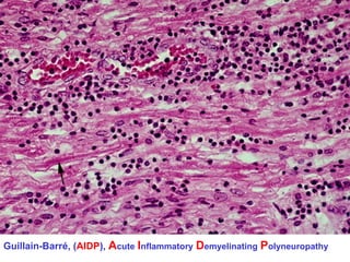 Guillain-Barré, (AIDP), Acute Inflammatory Demyelinating Polyneuropathy

 