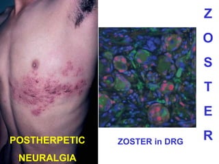 Z
O
S
T
E
POSTHERPETIC
NEURALGIA

ZOSTER in DRG

R

 
